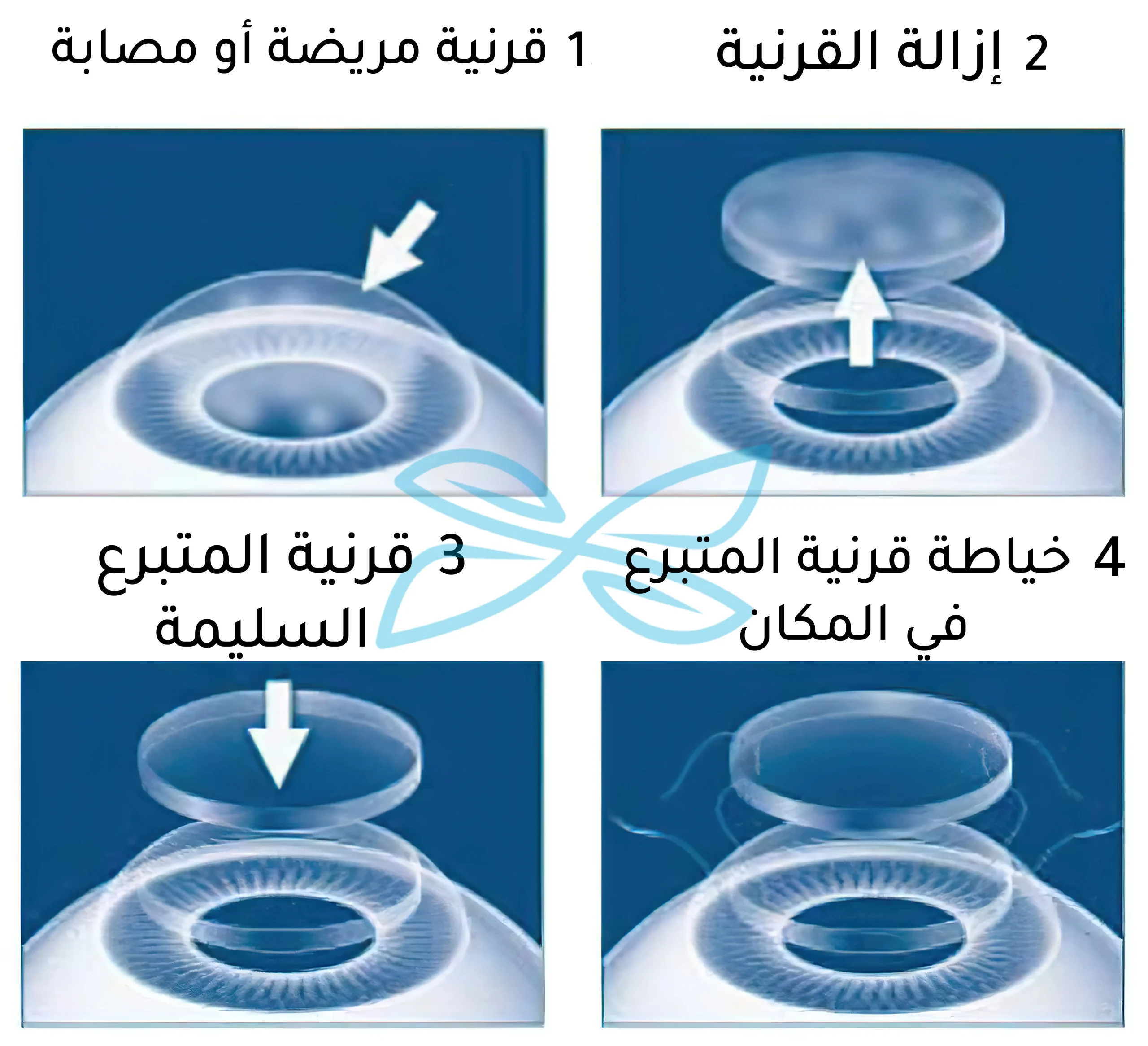 صورة ترسيمية توضح خطوات إجراء عملية زراعة القرنية كاملة السماكة