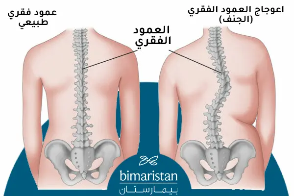 صورة ترسيمية توضح الفرق بين العمود الفقري الطبيعي والعمود الفقري المصاب بالجنف أو الاعوجاج