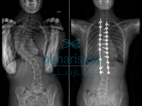 صورة شعاعية توضح القضيبين المتوازيين المستخدمين في تثبيت العمود الفقري في عملية كوتريل دوبوسيت