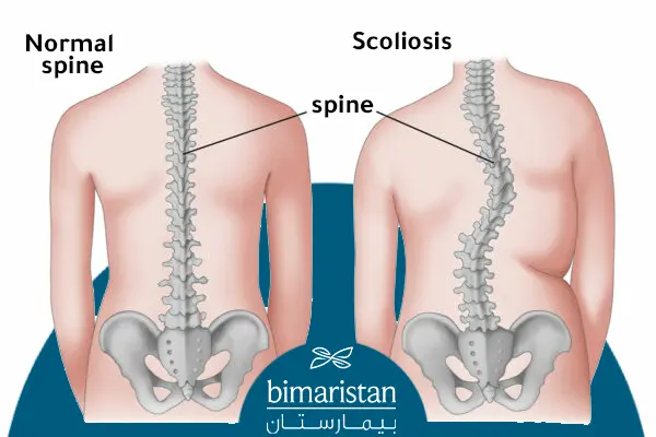 The Difference Between Normal Curvature Of The Spine And Scoliosis Of The Spine