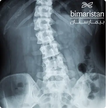 صورة شعاعية توضح اعوجاج العمود الفقري (مرض الجنف) في المنطقة الظهرية القطنية 