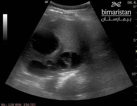 Pediatric Enlarged Spleen (Multiple Occult Intrasplenic Abscess)