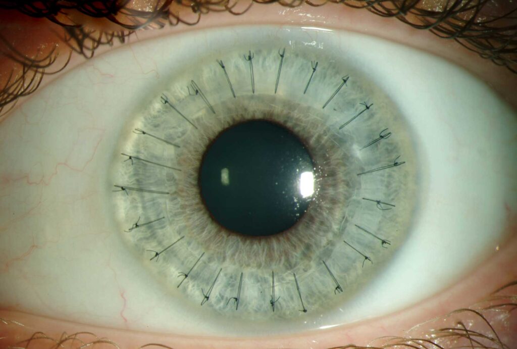 An Image Showing The Process Of Full Thickness Of Cornea Transplantation In Türkiye