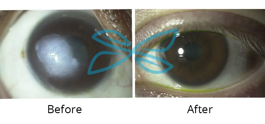 Surgical Transplant Of The Cornea