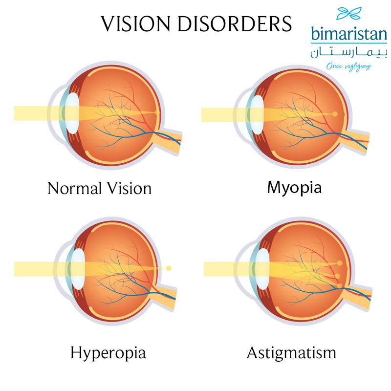 Image Illustrating The Refractive Error That Causes Blurry Eye Disease