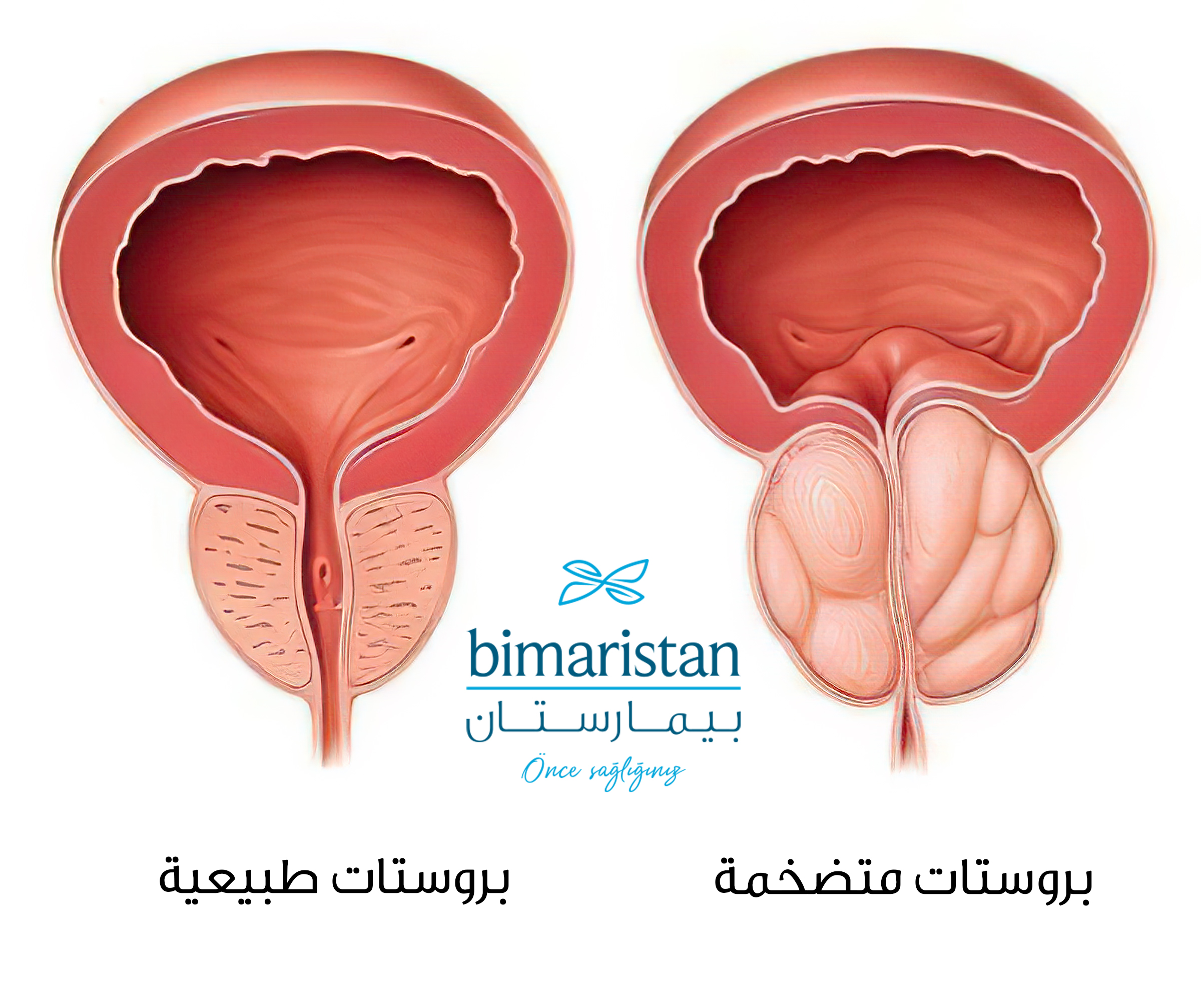 صورة توضح ضخامة البروستات الحميدة