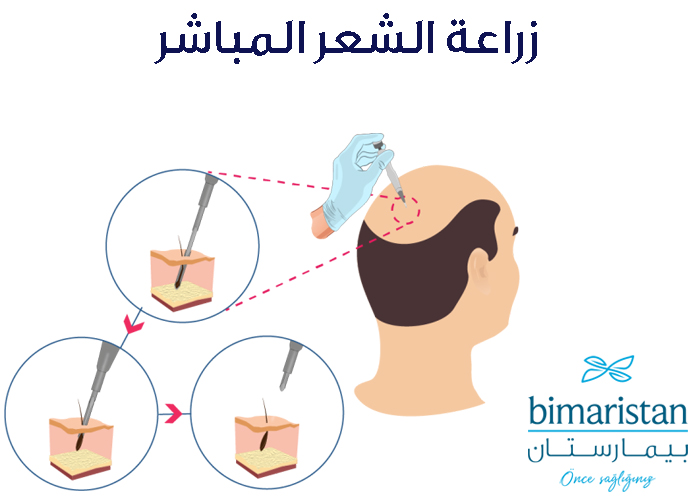 صورة ترسيمية توضح خطوات زراعة الشعر المباشر بواسطة قلم تشوي