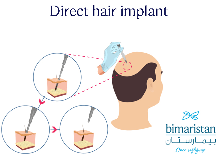 Steps Of Choi Pen Hair Transplant In Turkey