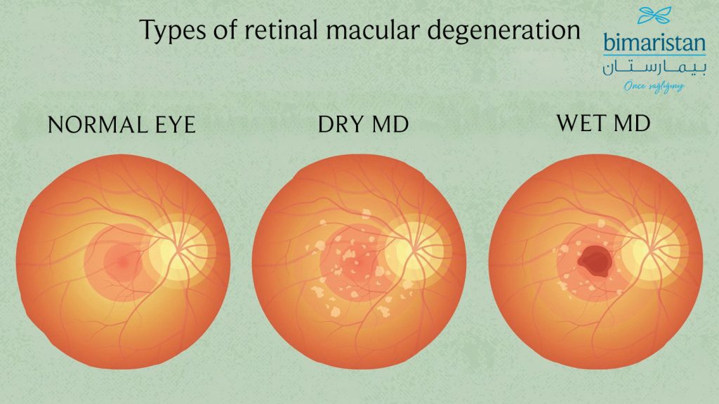 Top 10 Causes of Blurry Vision (Foggy eyes) - Bimaristan