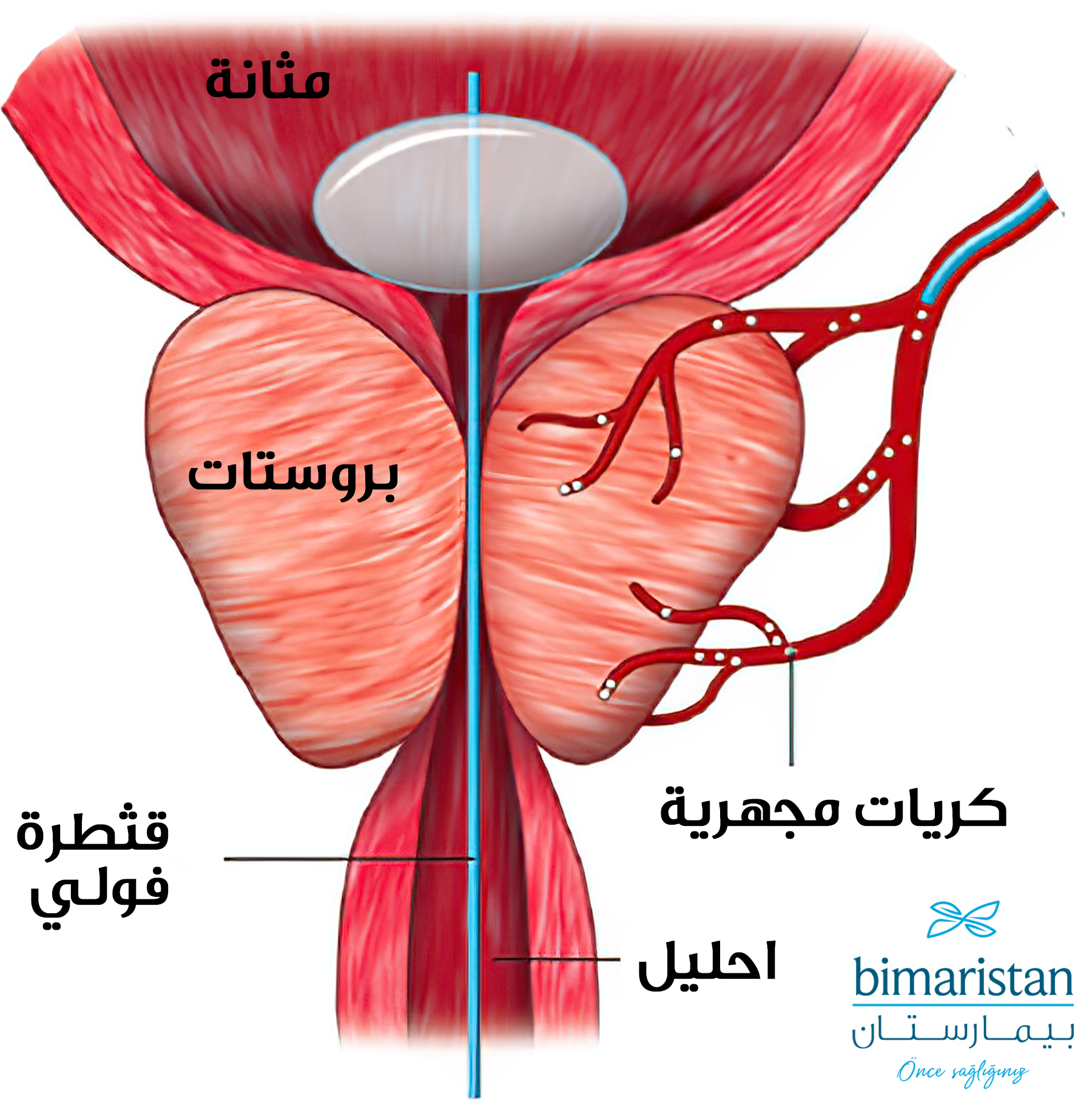 صورة توضح عملية إصمام الشريان البروستاتي