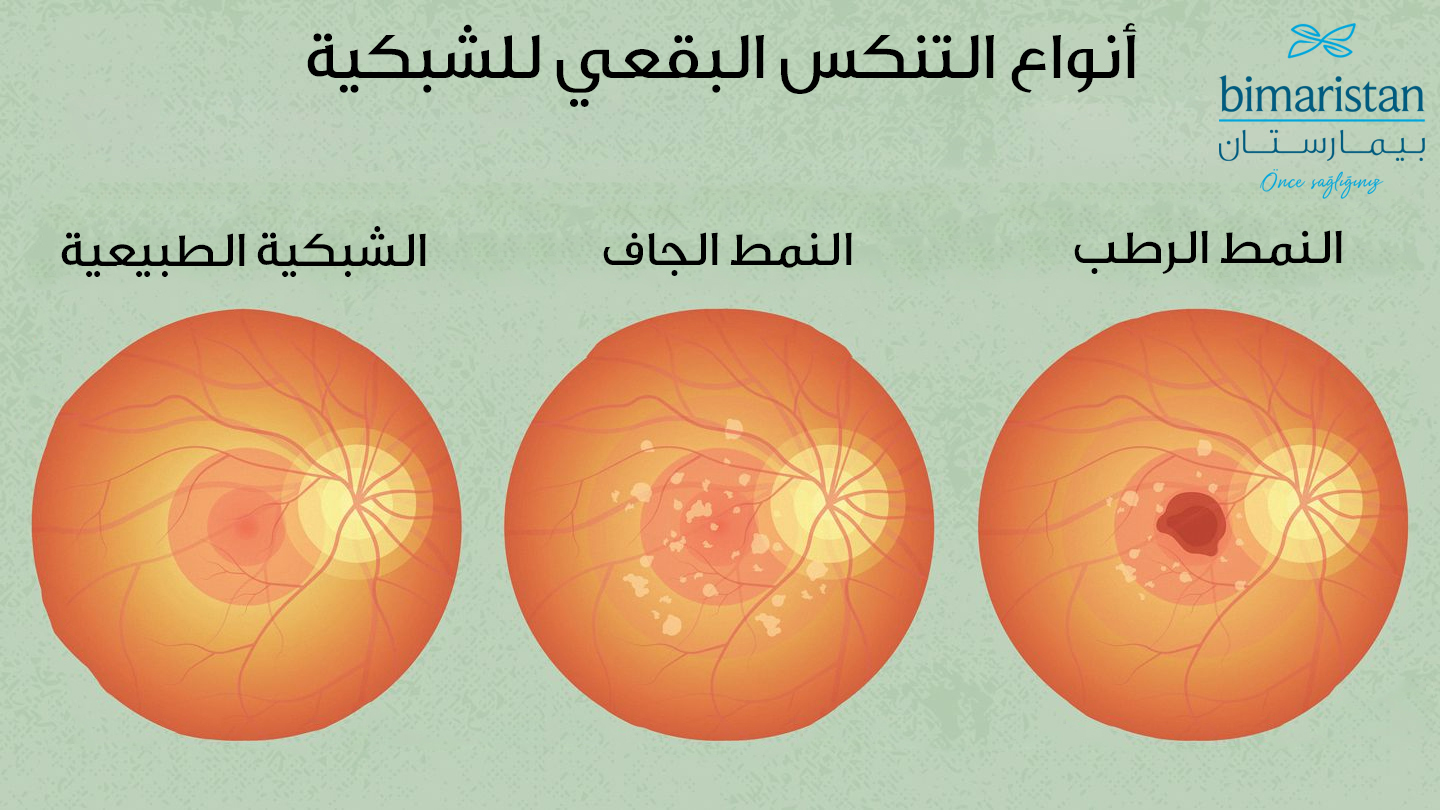 صورة توضح التنكس البقعي للشبكية المسبب لمرض ضبابية العين عند المسنين