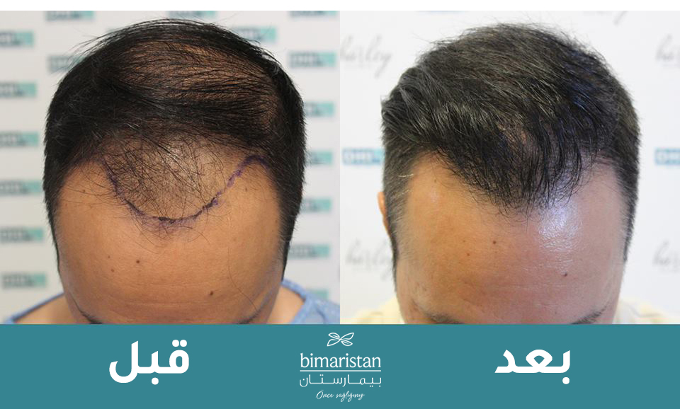 صورة توضح الفرق لمريض قبل وبعد إجراء عملية زراعة الشعر بتقنية Dhi