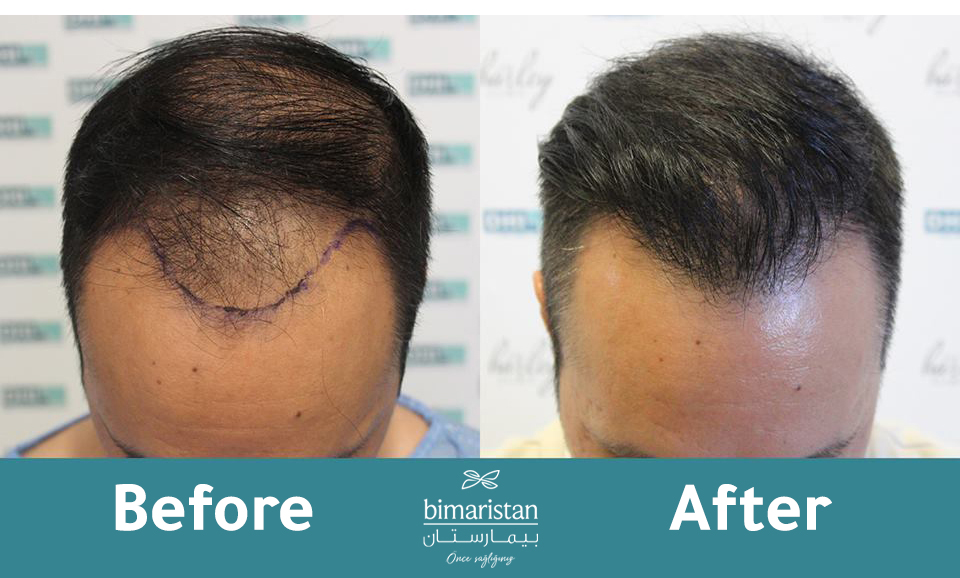 Dhi Before And After The Transplantation In Turkey