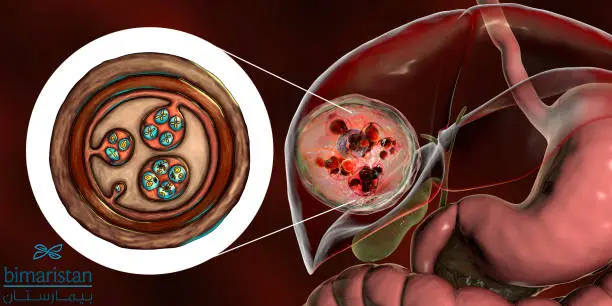 The Liver Hydatid Cyst, Daughter Cyst, And The Double-Strand Membrane Of The Cyst