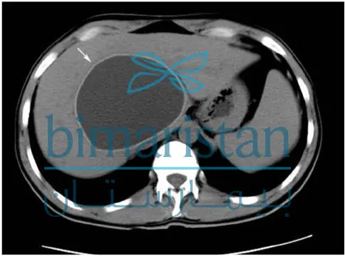 Liver Hydatid Cyst In Ct Scan