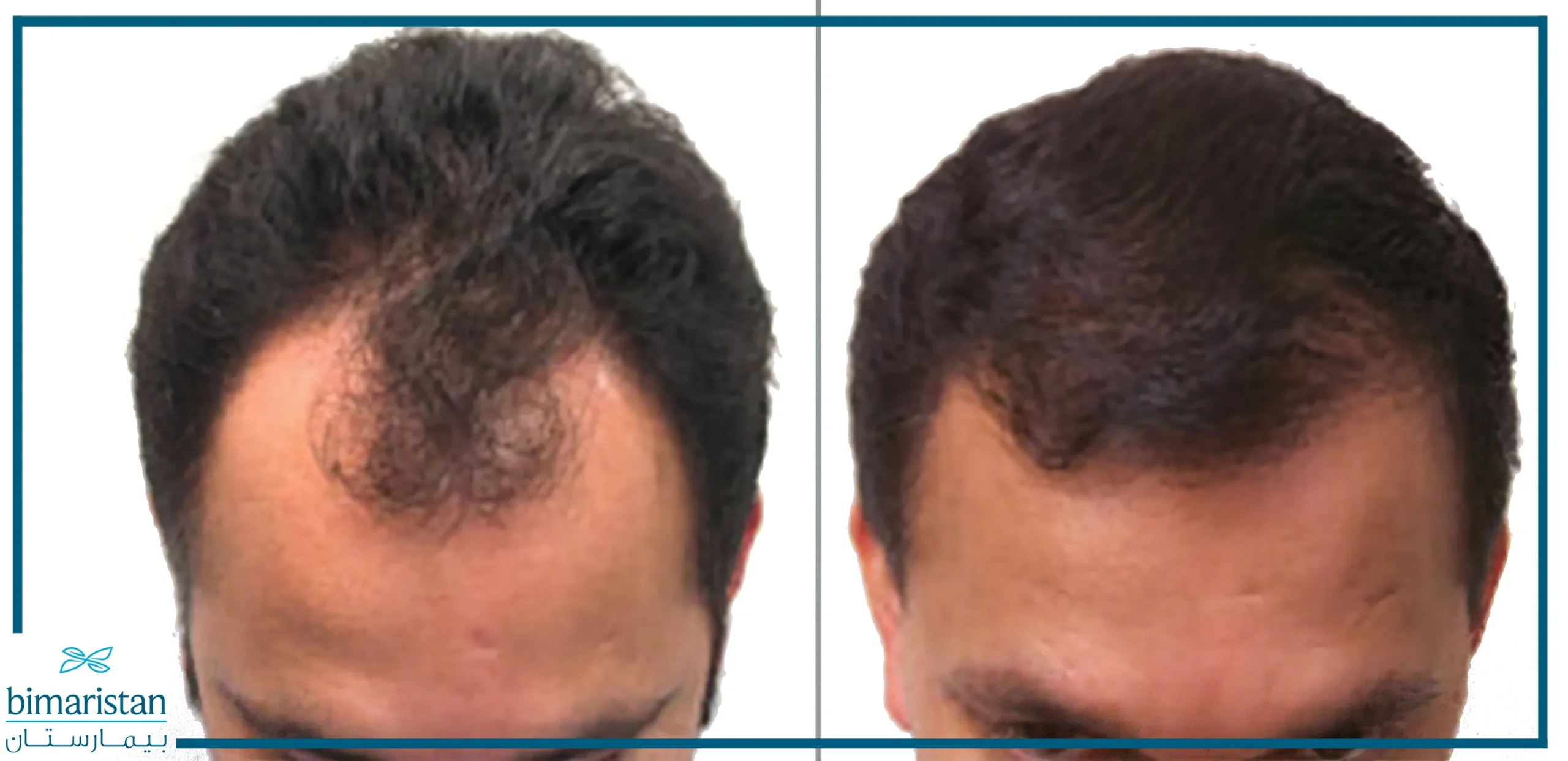 صورة لمريض زراعة الشعر قبل وبعد إجراء عملية زراعة الشعر بالروبوت