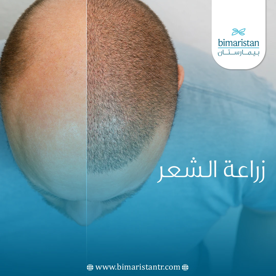 زراعة الشعر المباشر بالاقتطاف في تركيا