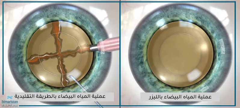 عملية المياه البيضاء بالليزر مقارنة مع الجراحة التقليدية