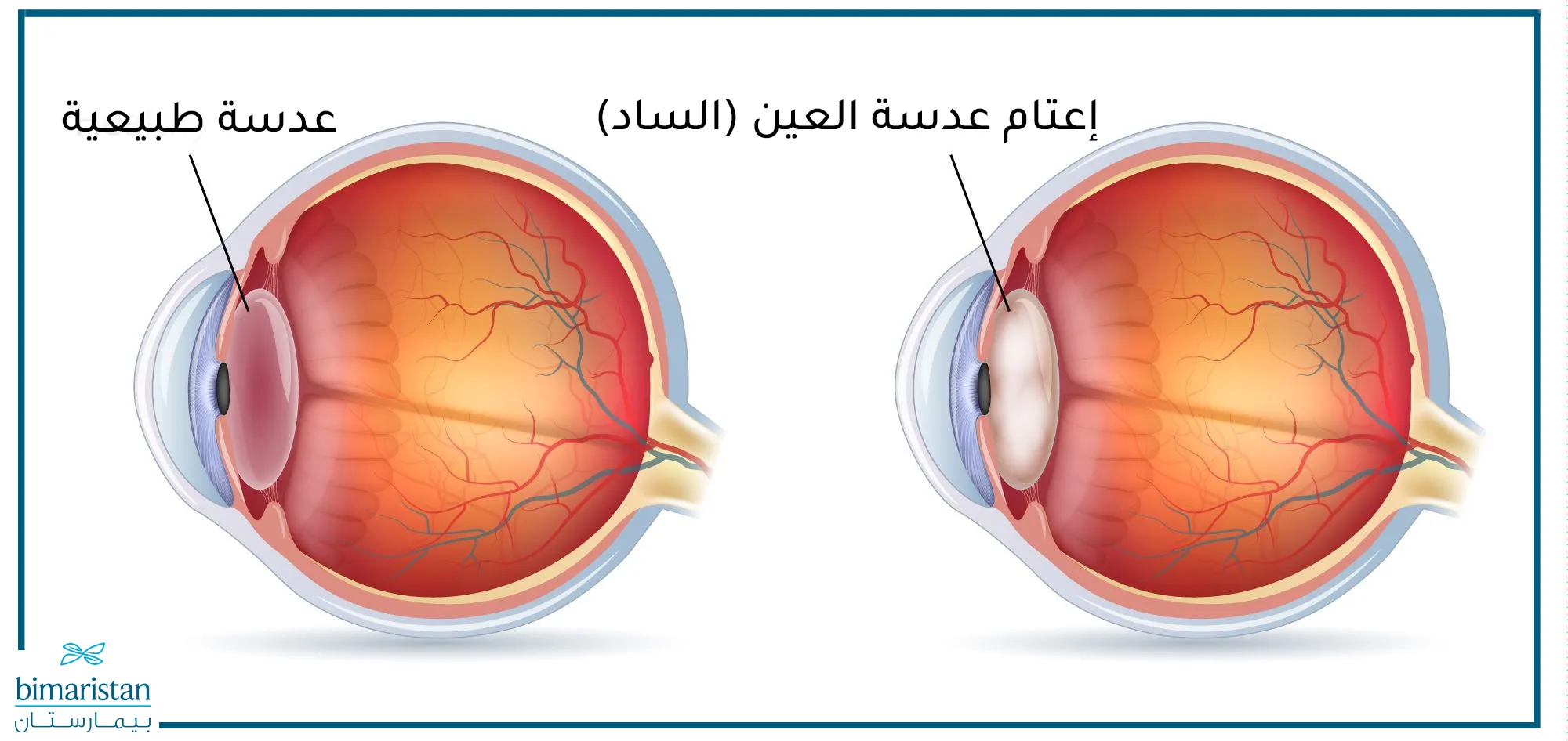 المياه البيضاء في العين (إعتام عدسة العين)