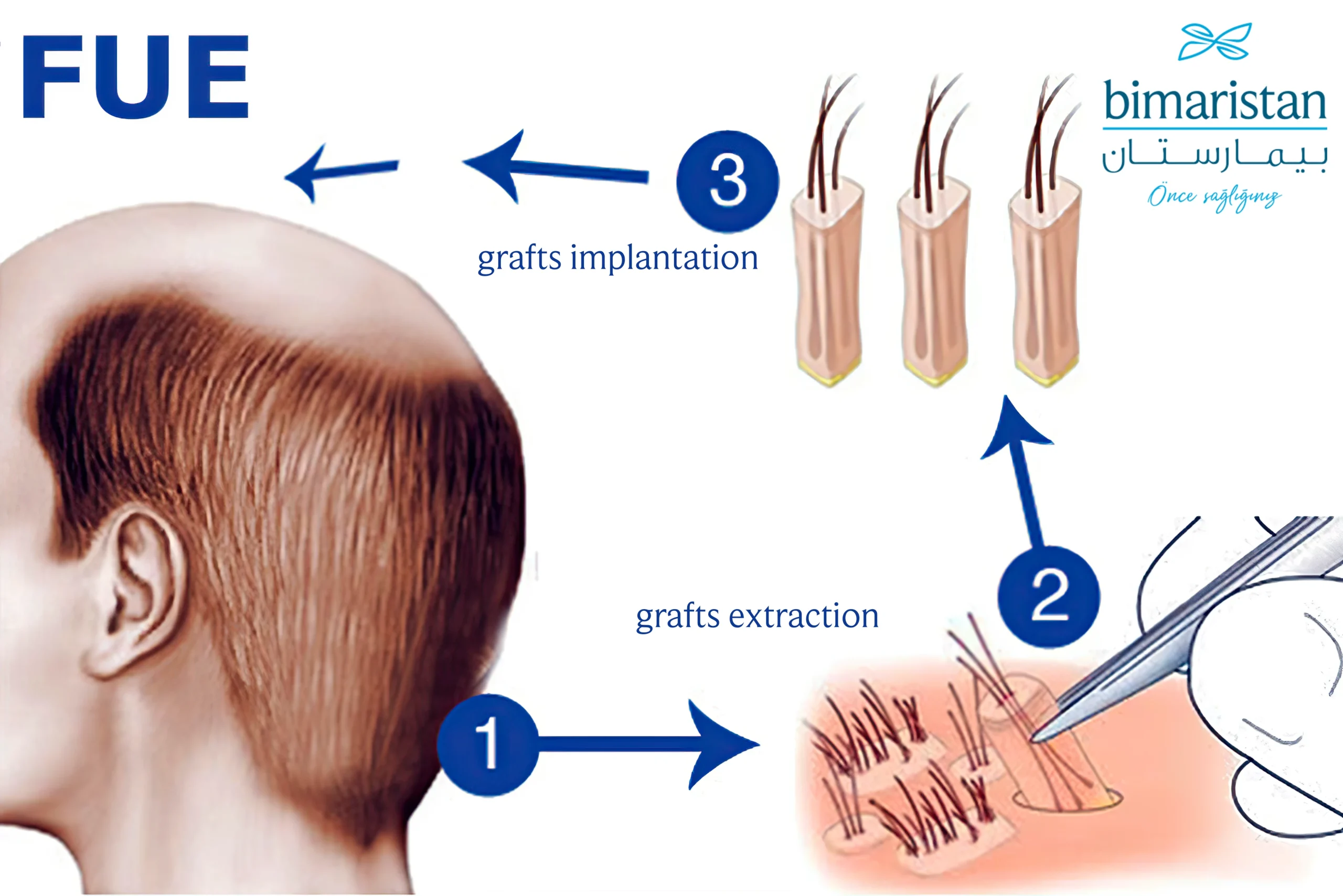 Follicular Unit Extraction Hair Transplant In Turkey