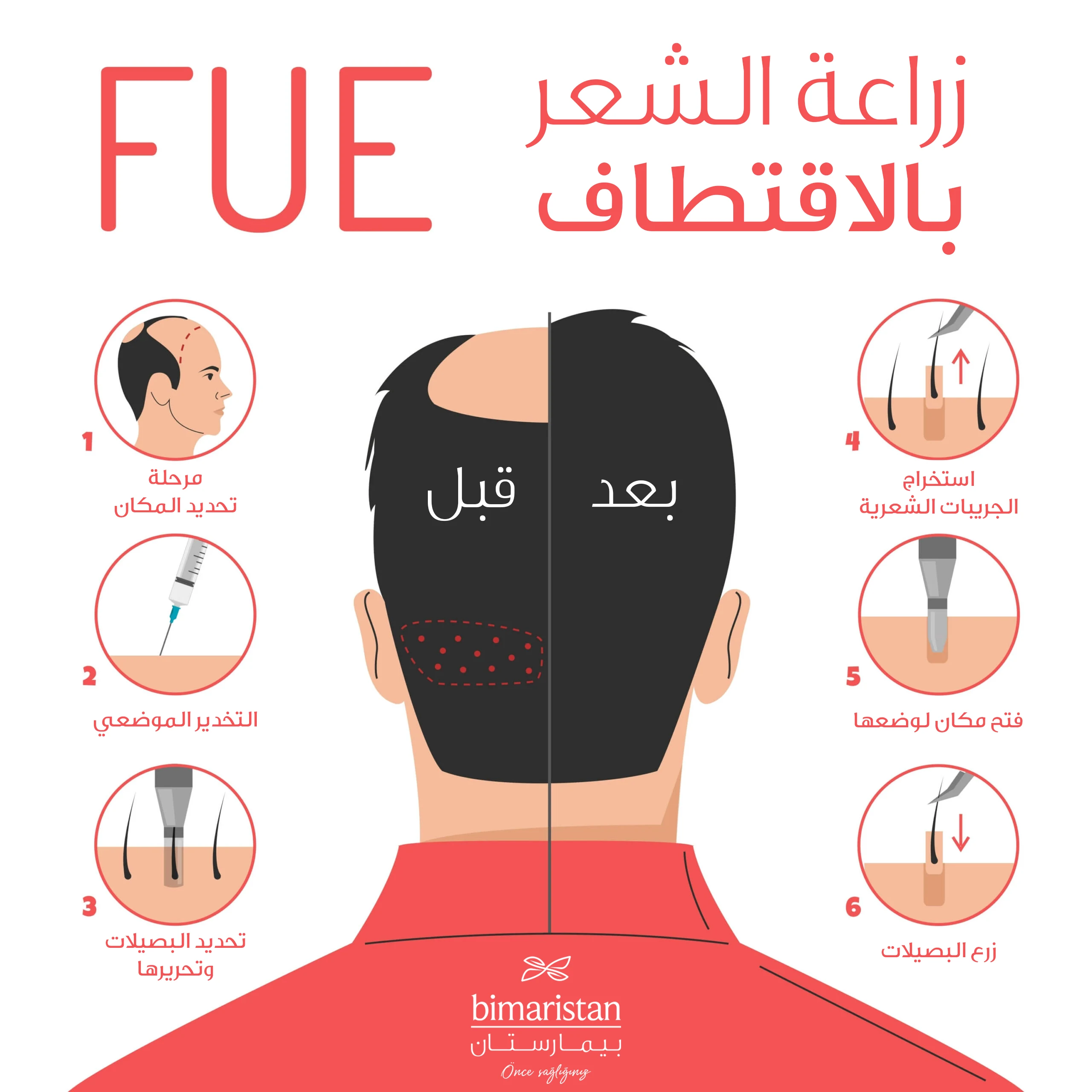 مراحل زراعة الشعر بالصور