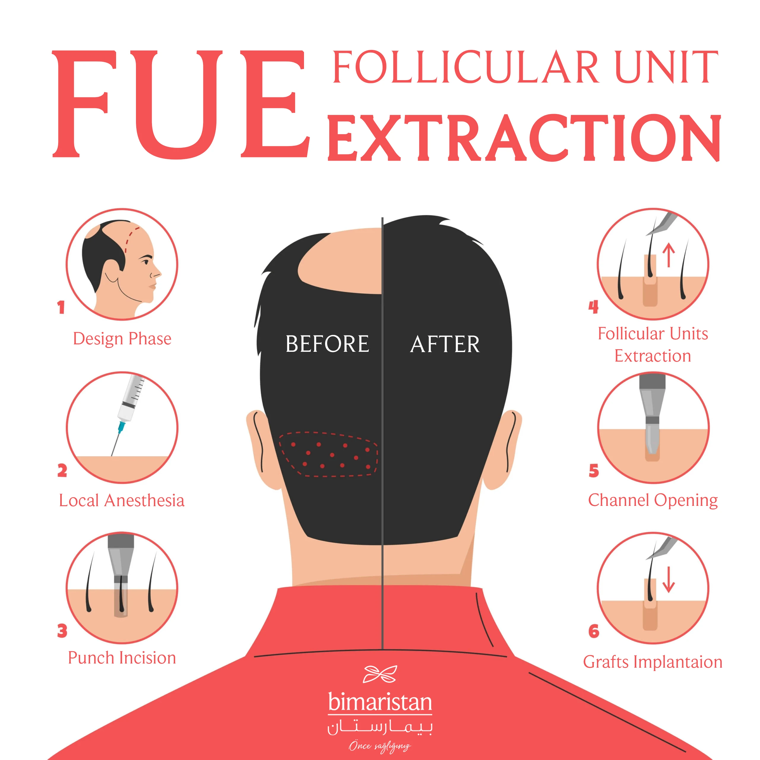 Stages Of Follicular Unit Extraction Procedure In Turkey