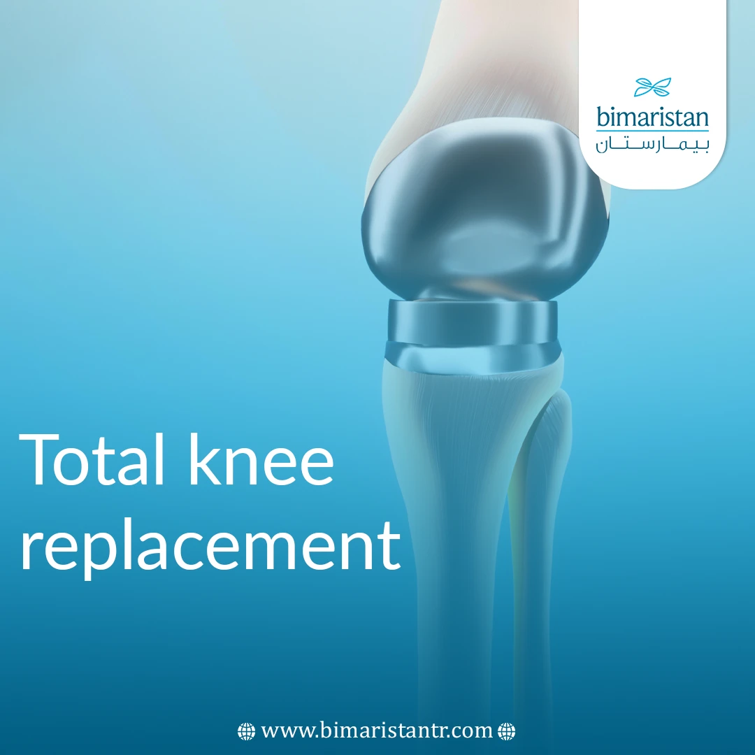 Total Knee Replacement