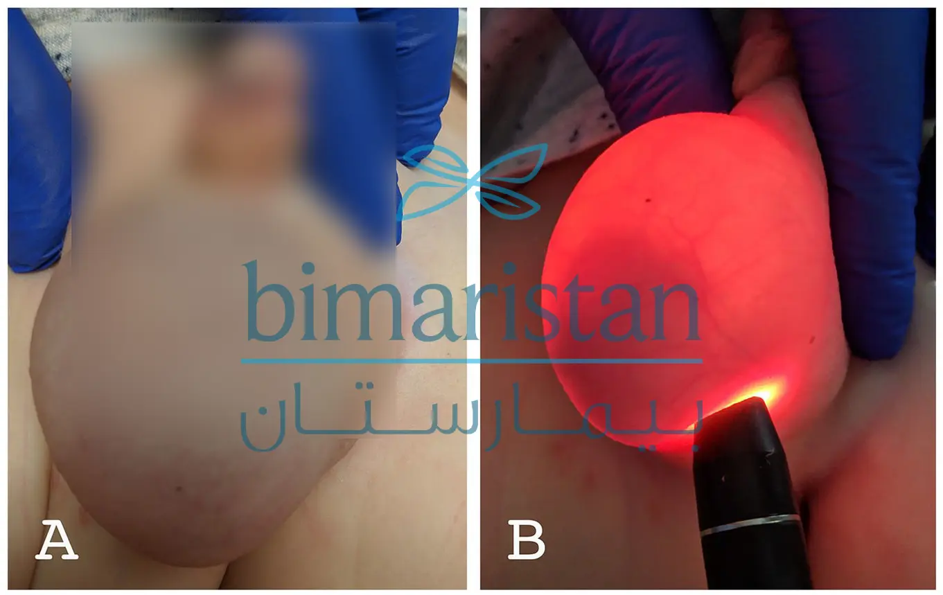 We Notice The Translucency Of Light When It Is Shined On The Hydrocele In The Scrotum