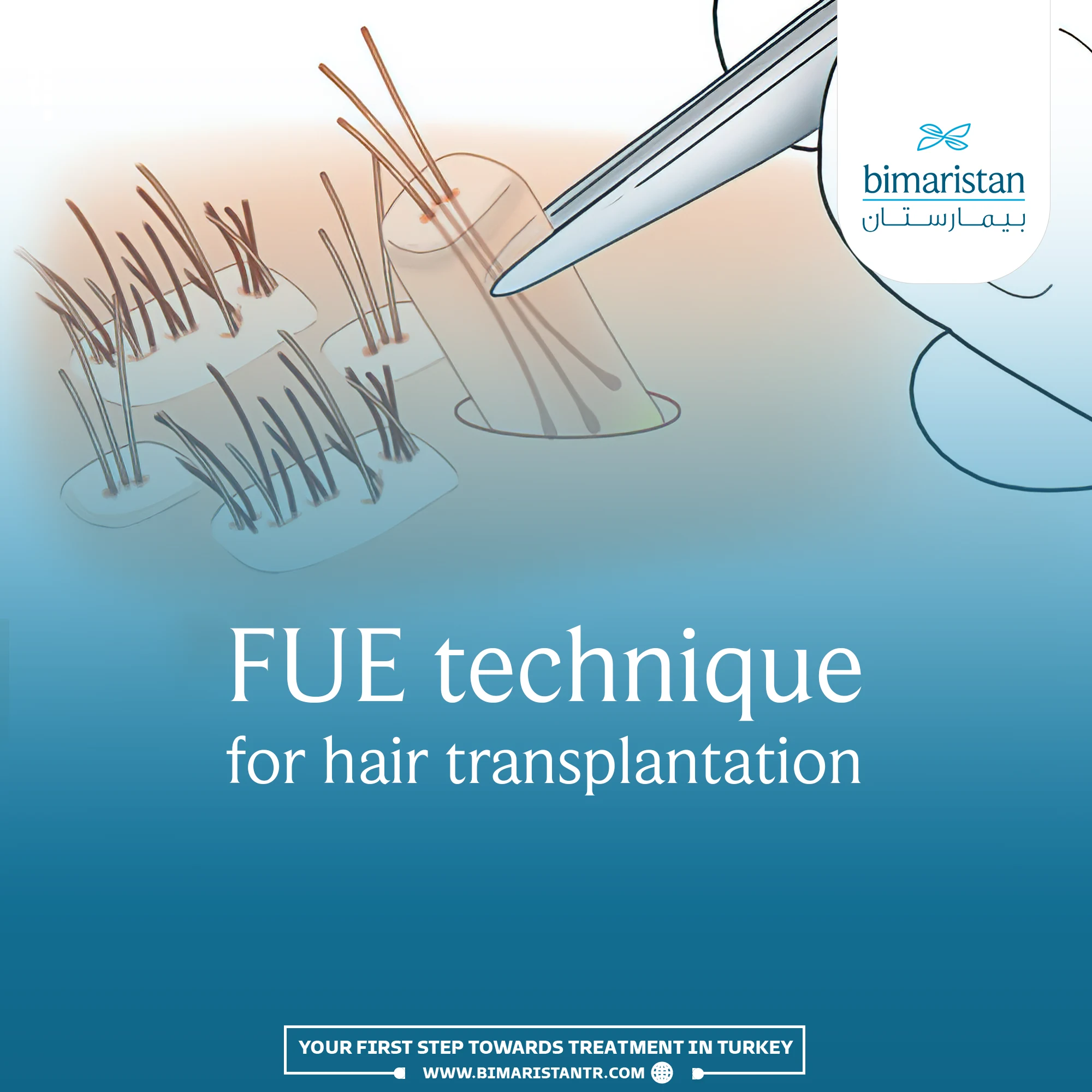 Cover Image For The Fue Hair Transplant Article