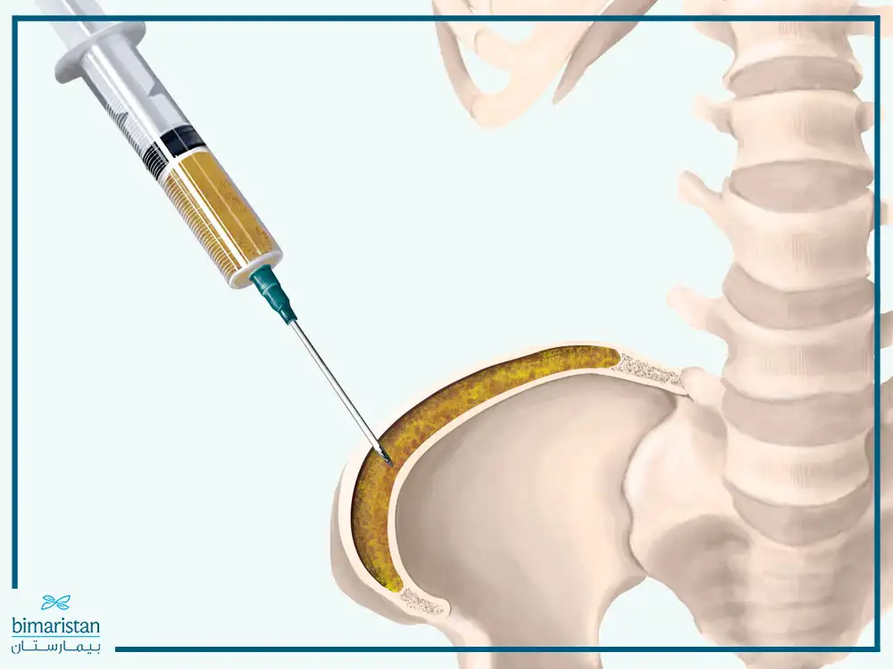 How To Withdraw Stem Cells From The Iliac Bone In Humans