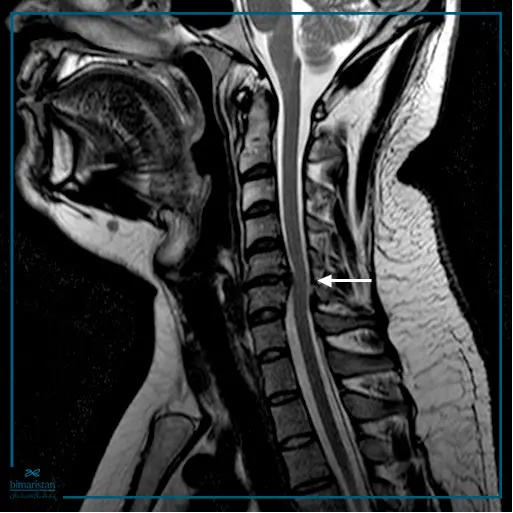 An Mri Image Showing A Disc In One Of The Cervical Vertebrae In A Patient Suffering From Neck Pain