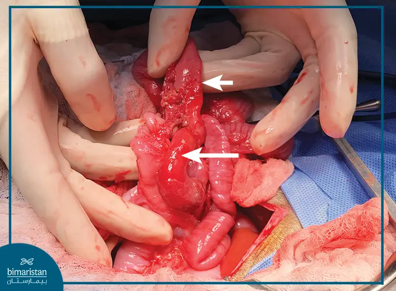 Infant Intussusception Surgery In Türkiye