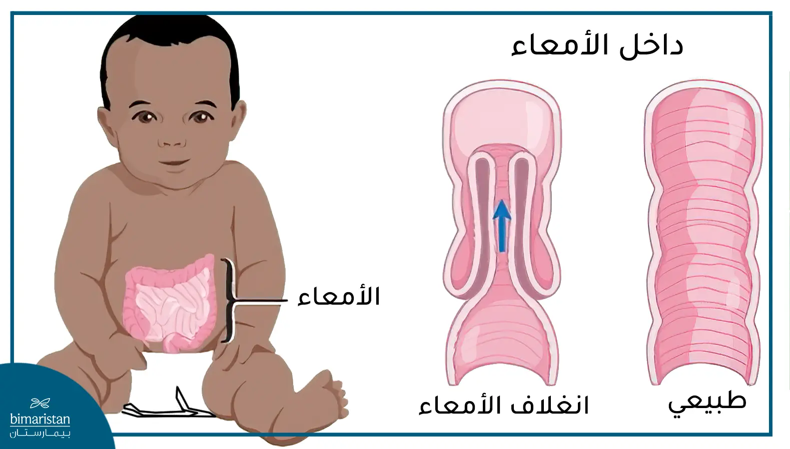 انغلاف الأمعاء عند الأطفال