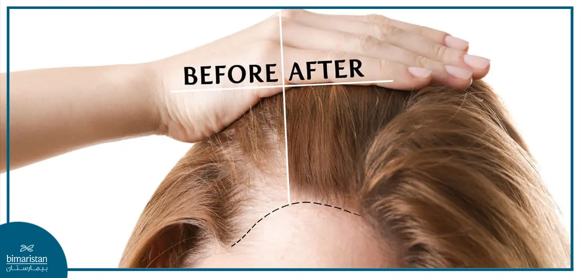 Before Amd After Hair Transplant For Women In Turkey