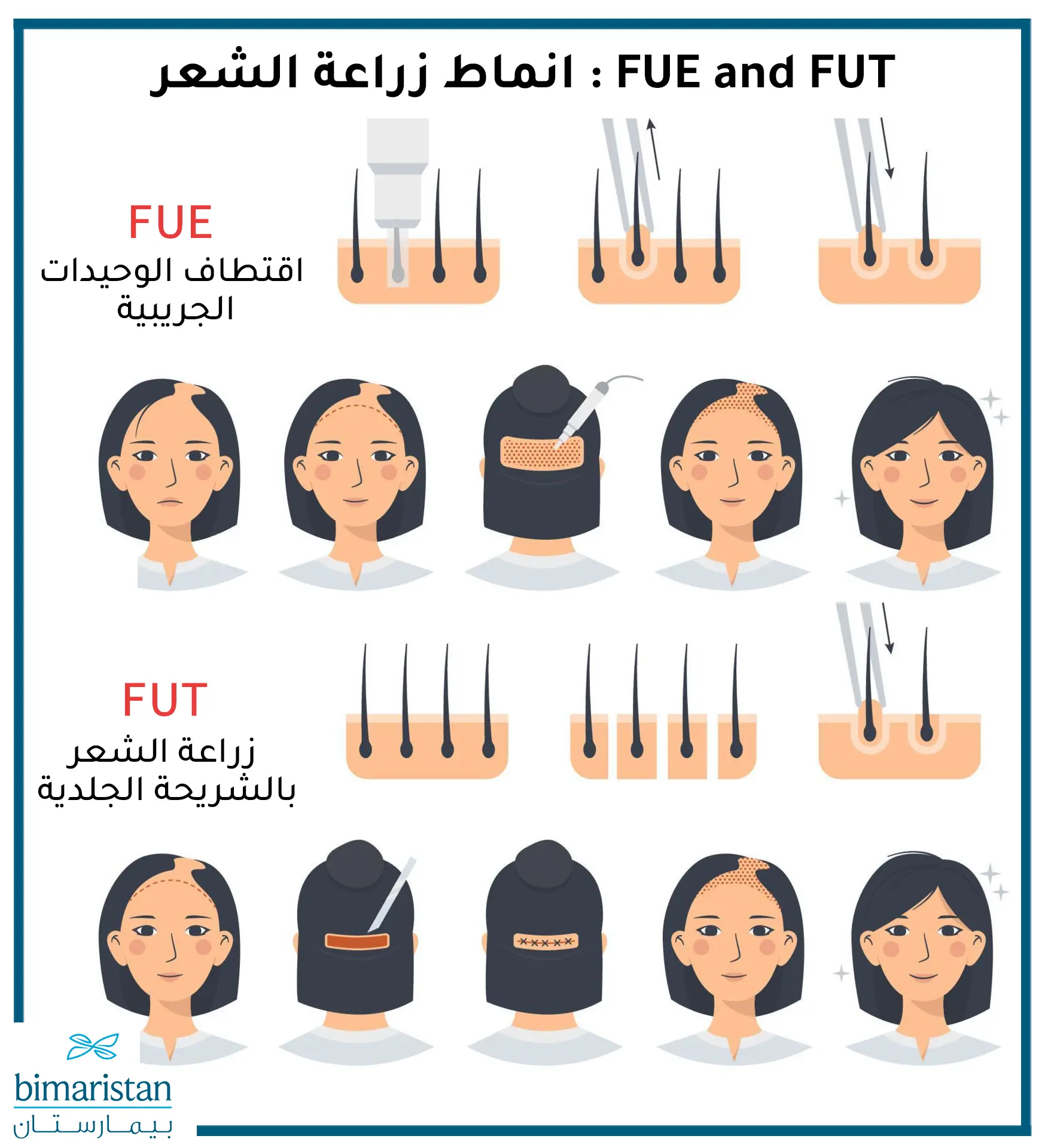 طريقة زراعة الشعر للنساء في تركيا