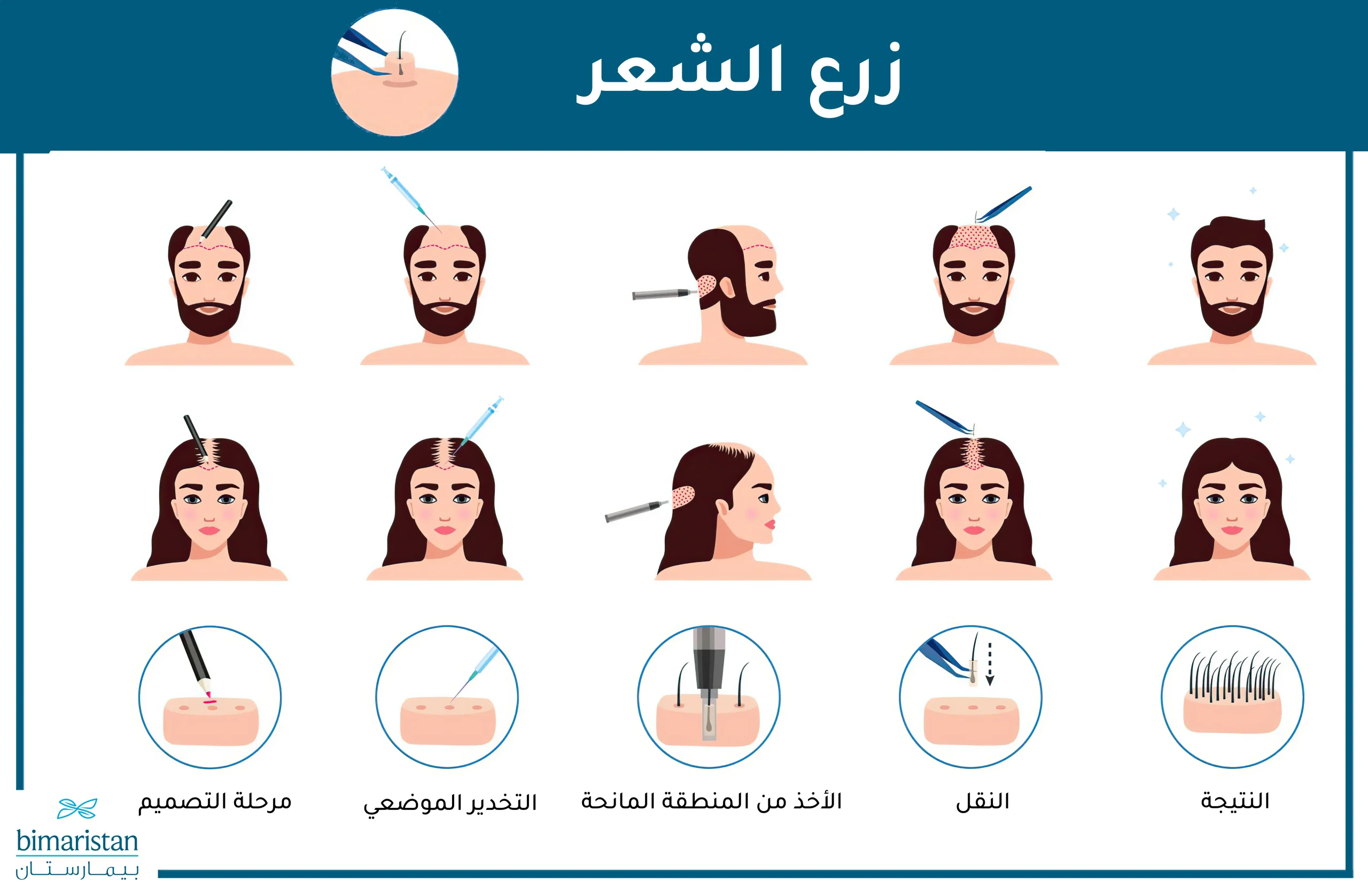 زراعة الشعر في مقدمة الرأس بشرح مبسط