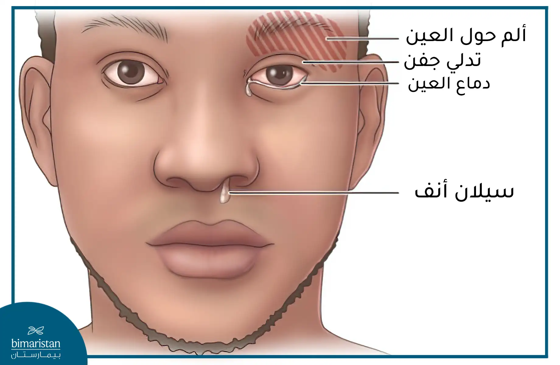 الصداع العنقودي والعين