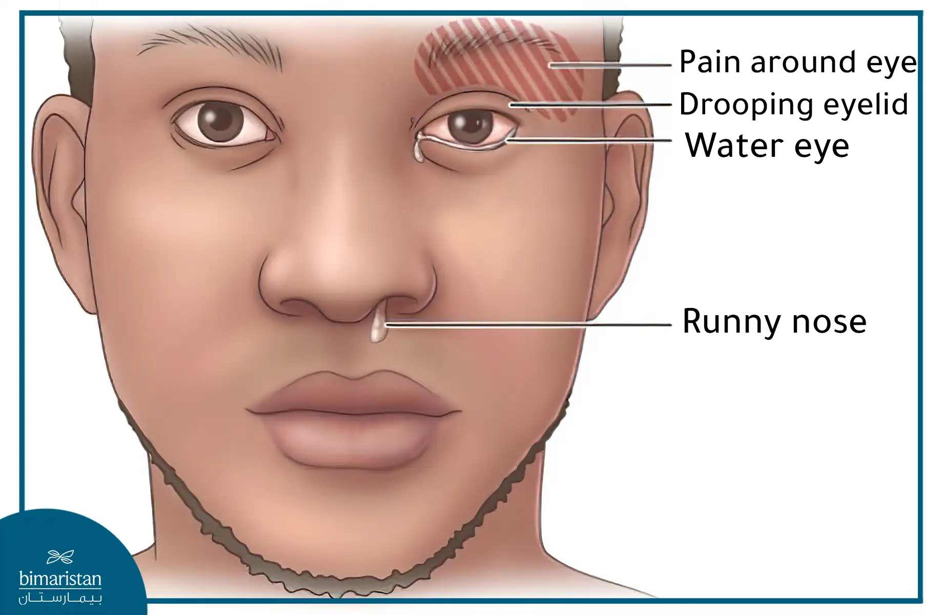 The Most Important Symptoms Of Cluster Head Pain