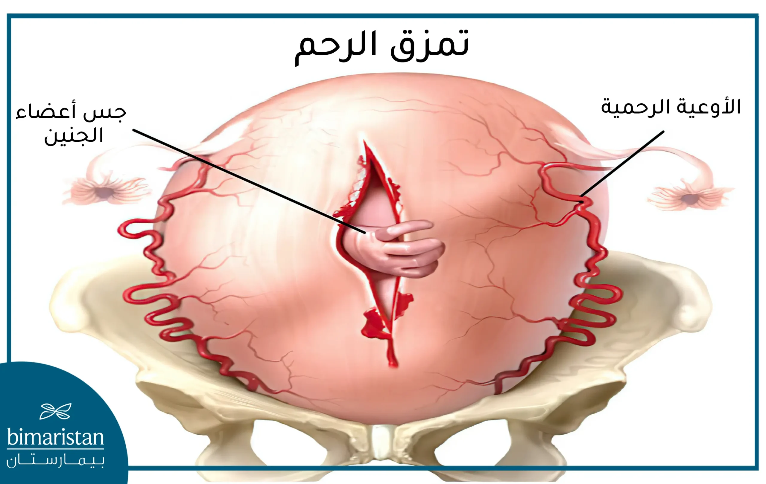  تمزق الرحم أثناء الحمل