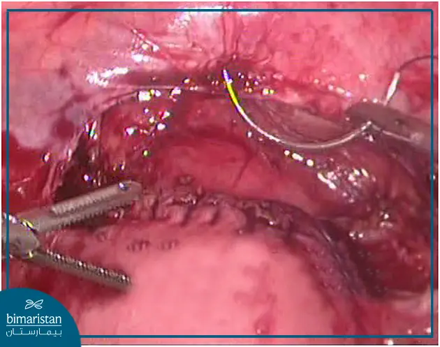 Suturing Uterine Tear During Laparoscopic Uterine Surgery In Turkey