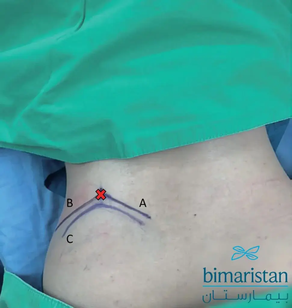 The Lines Drawn For The Endoscopic Discectomy