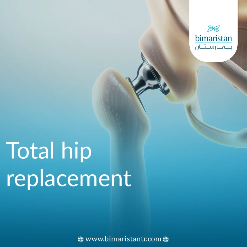 Total Hip Replacement