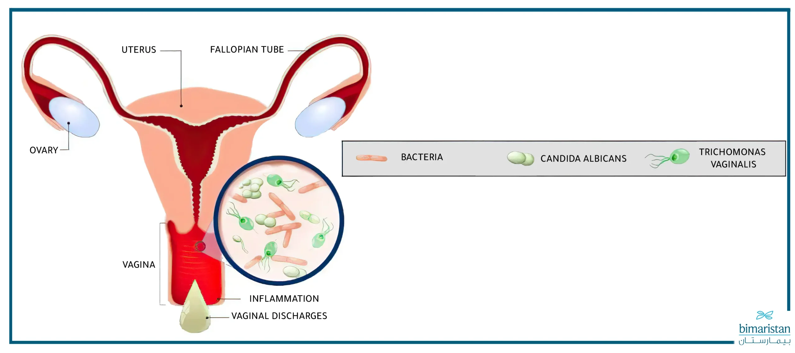 A Picture Illustrating The Microorganisms That Cause Vaginitis In Married Women.