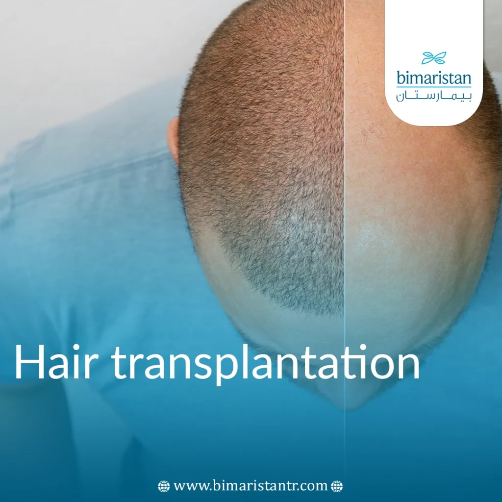 Hair Transplantation