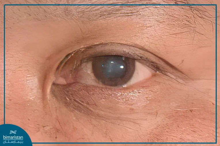 Cataract Appearance