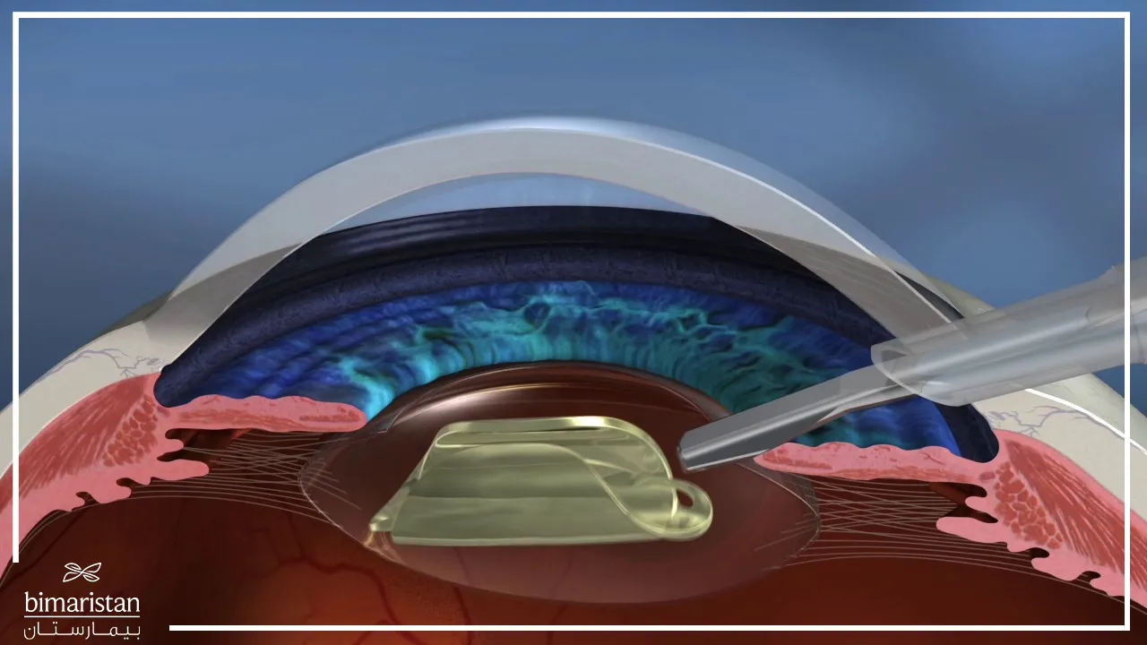 Artificial Lens Implant