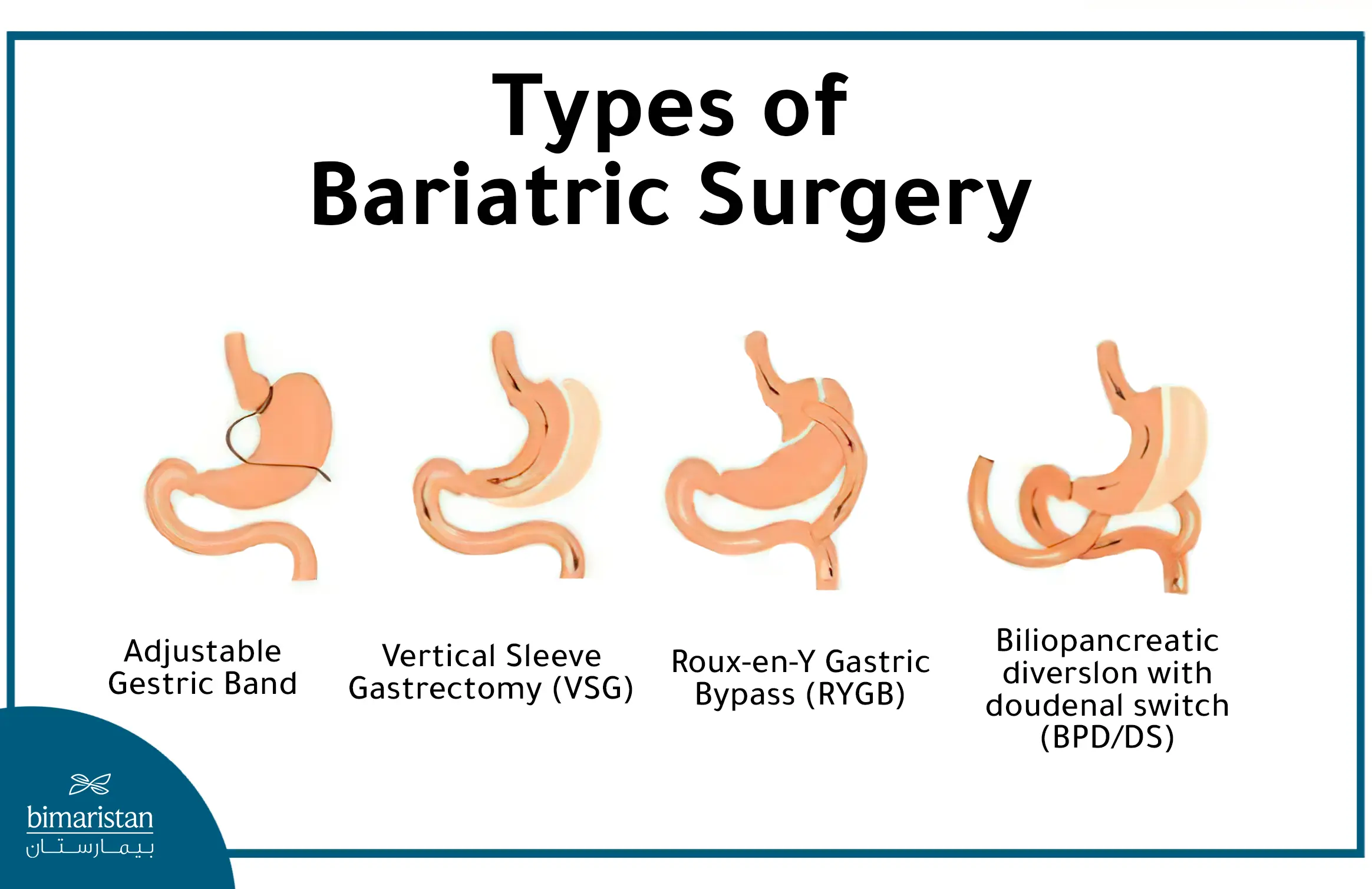 The Different Types Of Bariatric Surgery In Turkey