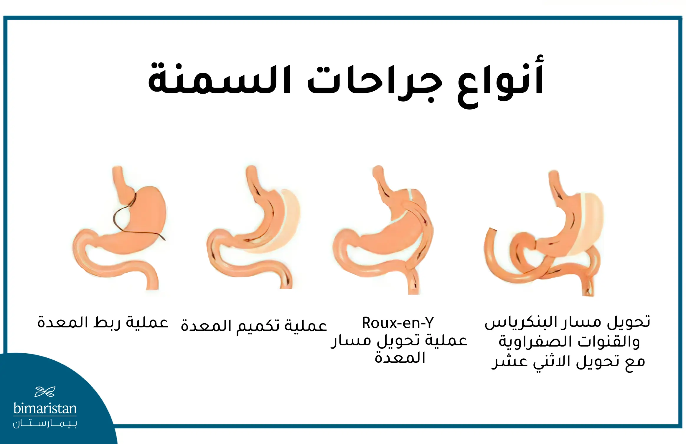 أنواع جراحات علاج السمنة في تركيا