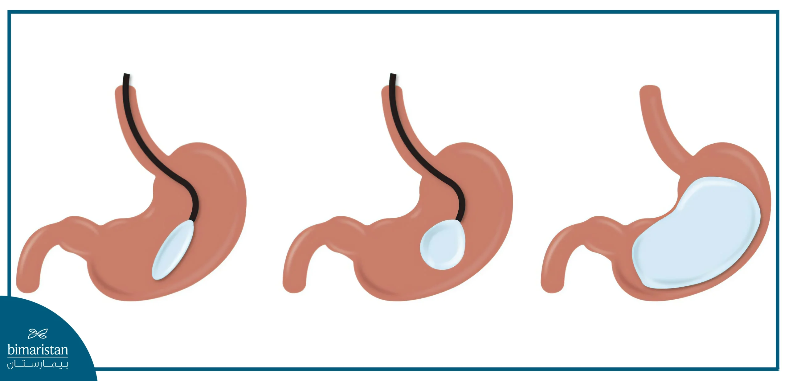 This Is How Gastric Balloon Looks Like Inside Your Stomach