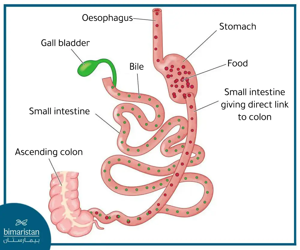 This Is How Intestine Looks Like After Biliopancreatic Diversion With Duodenal Switch Surgery